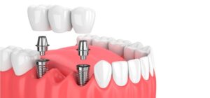 Colocación del diente sobre un implante dental